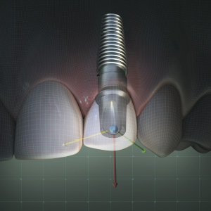 Digital Scanning and Implants eBook Thumbnail