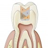 Fig 1. Typically for preparations > 2 mm, numerous layers of composite must be placed into the preparation to diminish polymerization shrinkage and stresses on tooth structure.