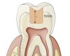 Fig 3. For shallow preparations up to 4 mm, bulk-fill dentin and enamel replacement composites are available that can be placed in a single increment.