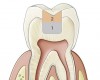 Fig 4. When preparation depths approach 6 mm, the use of two increments (eg, a dentin replacement layer deep in the preparation that is topped with a modern composite) has been advocated.