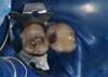 Fig 5. Preoperative view of a patient who presented with two defective amalgam restorations requiring replacement.
