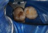 Fig 6. The amalgam restorations were thoroughly removed and the cavities prepared, after which caries indicator was applied to ensure the presence of only healthy, caries-free tooth structure.