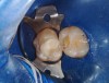 Fig 10. Given the depth of the preparation, the restoration was completed by placing an increment of a nanohybrid composite on top of the flowable bulk-fill dentin replacement.
