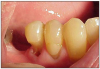 Figure 9. Toothbrush Abrasion. Image presented with permission from Martin Spiller, DMD www.doctorspiller.com.