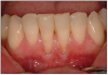 Figure 10. Gingival Recession. Image presented with permission from www.implantdentist.co.nz.