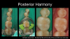 Fig 2. In this case, there was a need for dentin and enamel shades in some areas and only enamel in others.