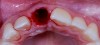Fig 8. Extraction site No. 8 after atraumatic removal of the tooth.