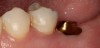 Fig 15. Custom titanium abutment No. 19 at delivery.