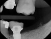Fig 17. Radiograph showing final restoration for implant No. 19.